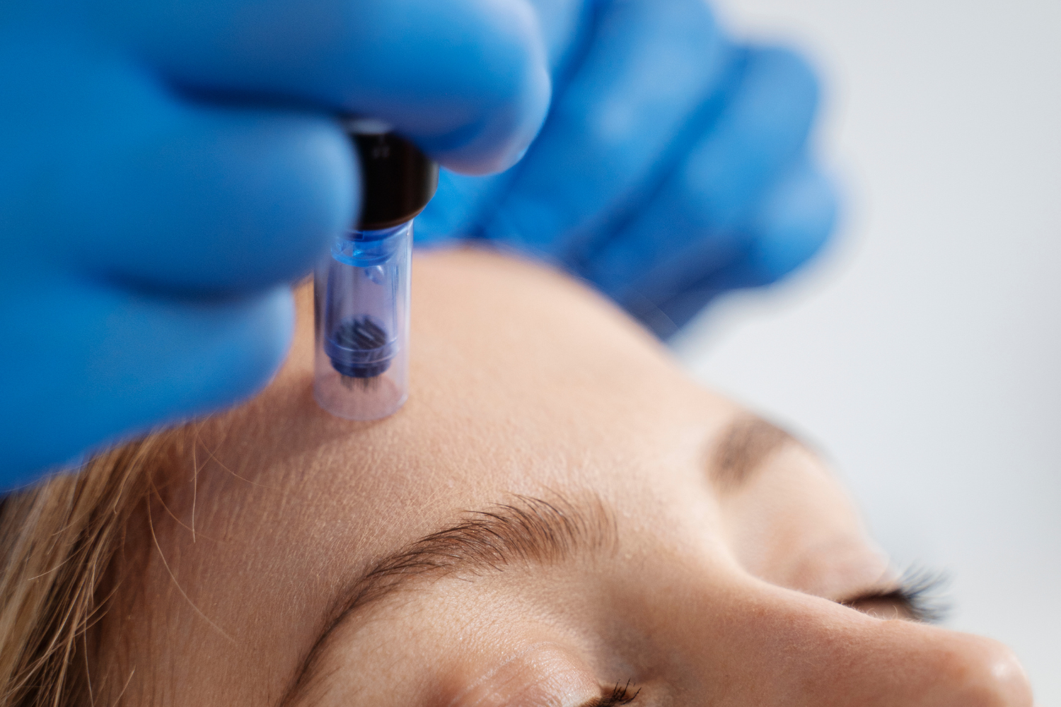 Microneedling à domicile : guide complet (résultats, erreurs, avant/après)