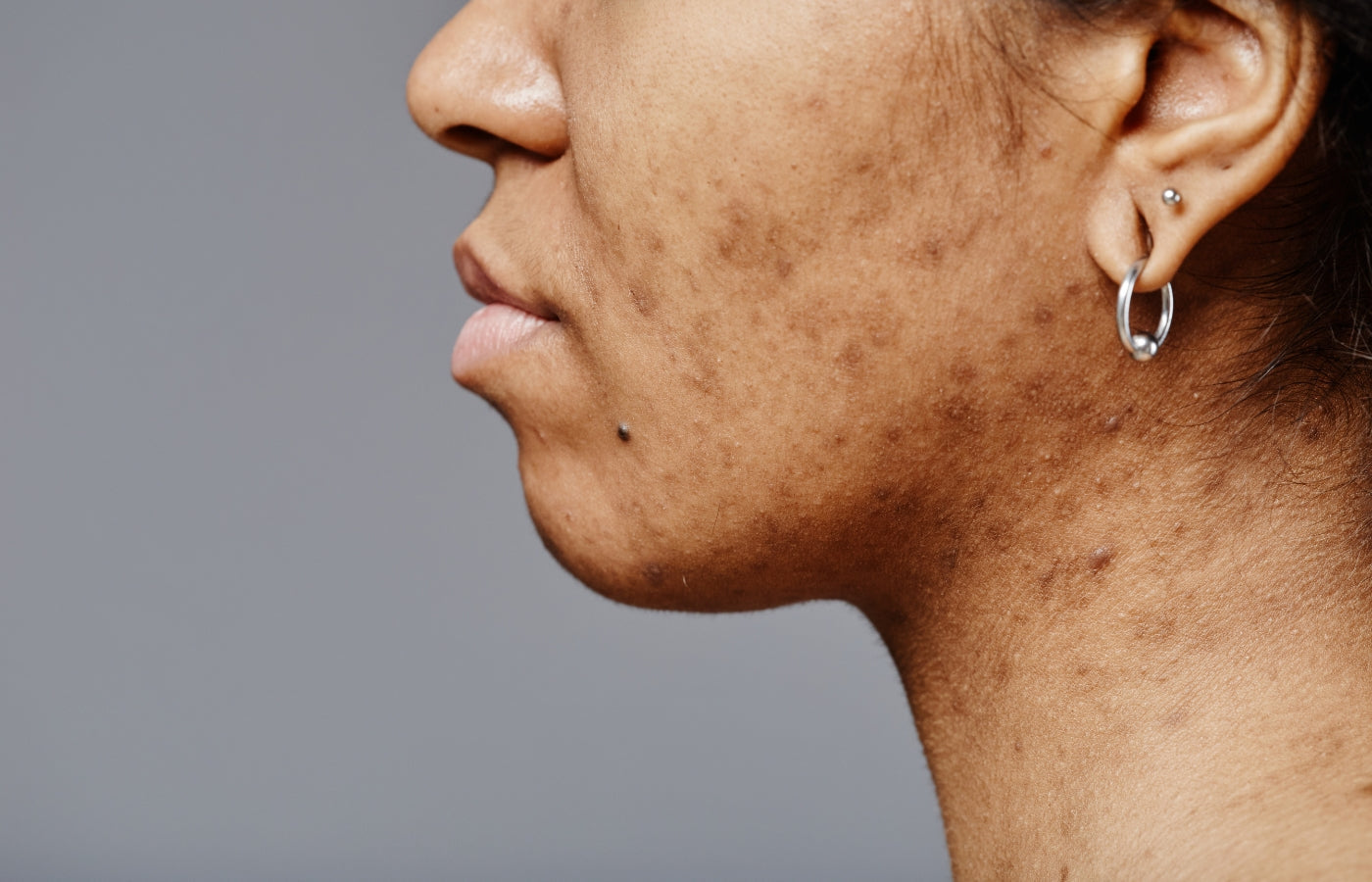 Microneedling et taches pigmentaires : comment atténuer visiblement les marques brunes ?