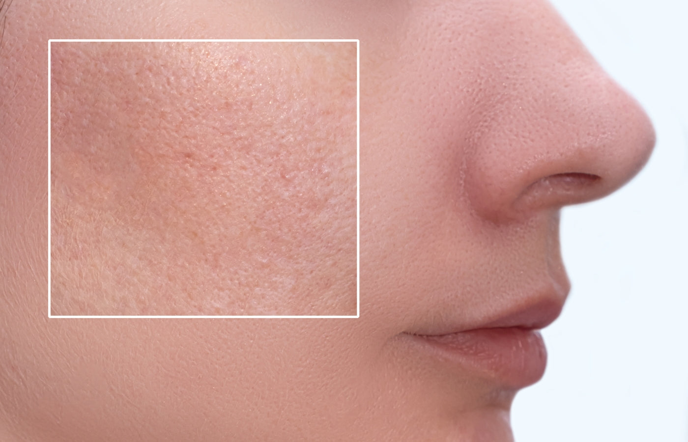 Microneedling et pores dilatés : peut-on réellement resserrer les pores ?