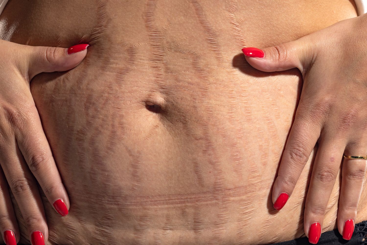Microneedling et vergetures : comment améliorer l’apparence de la peau ?