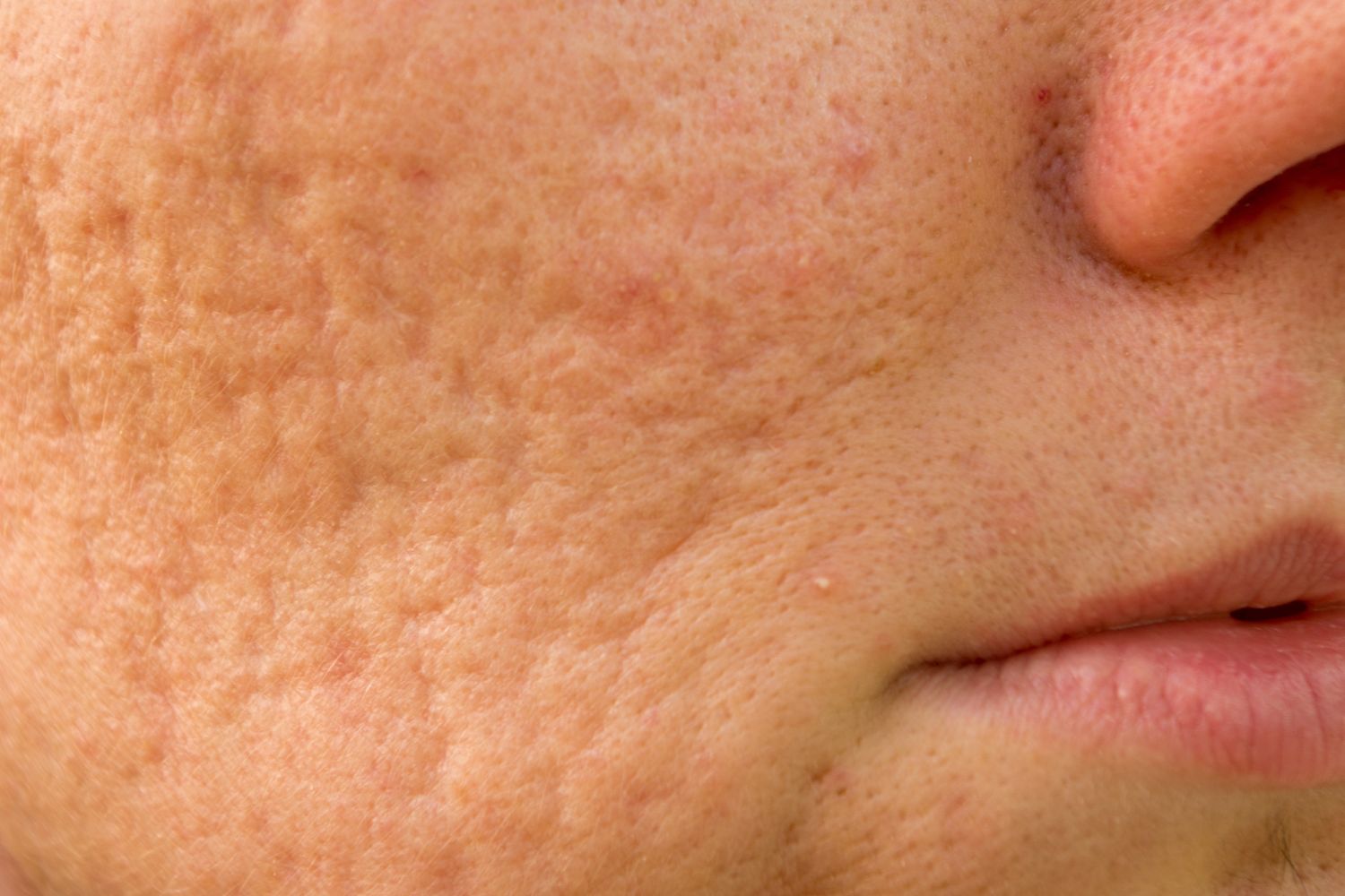 Microneedling et cicatrices d'acné : comment atténuer visiblement les marques ?