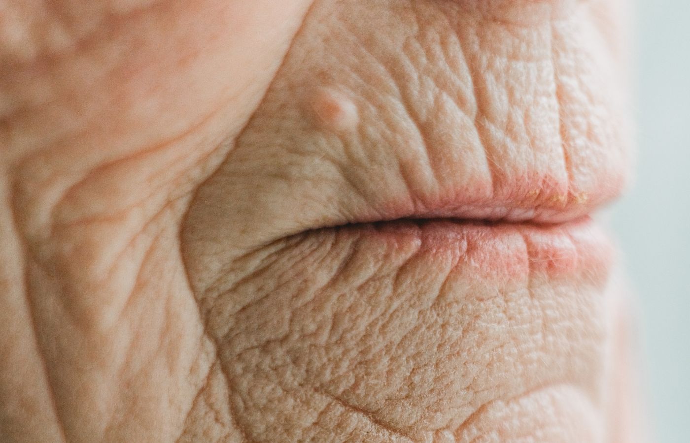 Microneedling et rides du fumeur : peut-il atténuer les ridules autour de la bouche ?